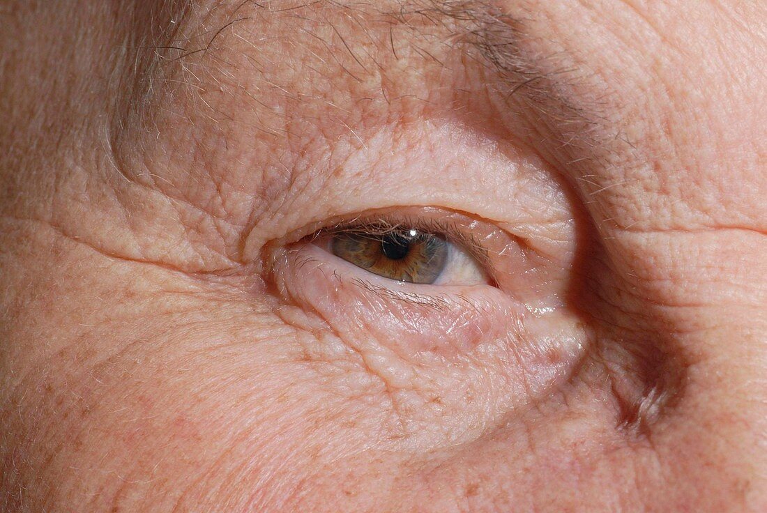 Elderly person's eye