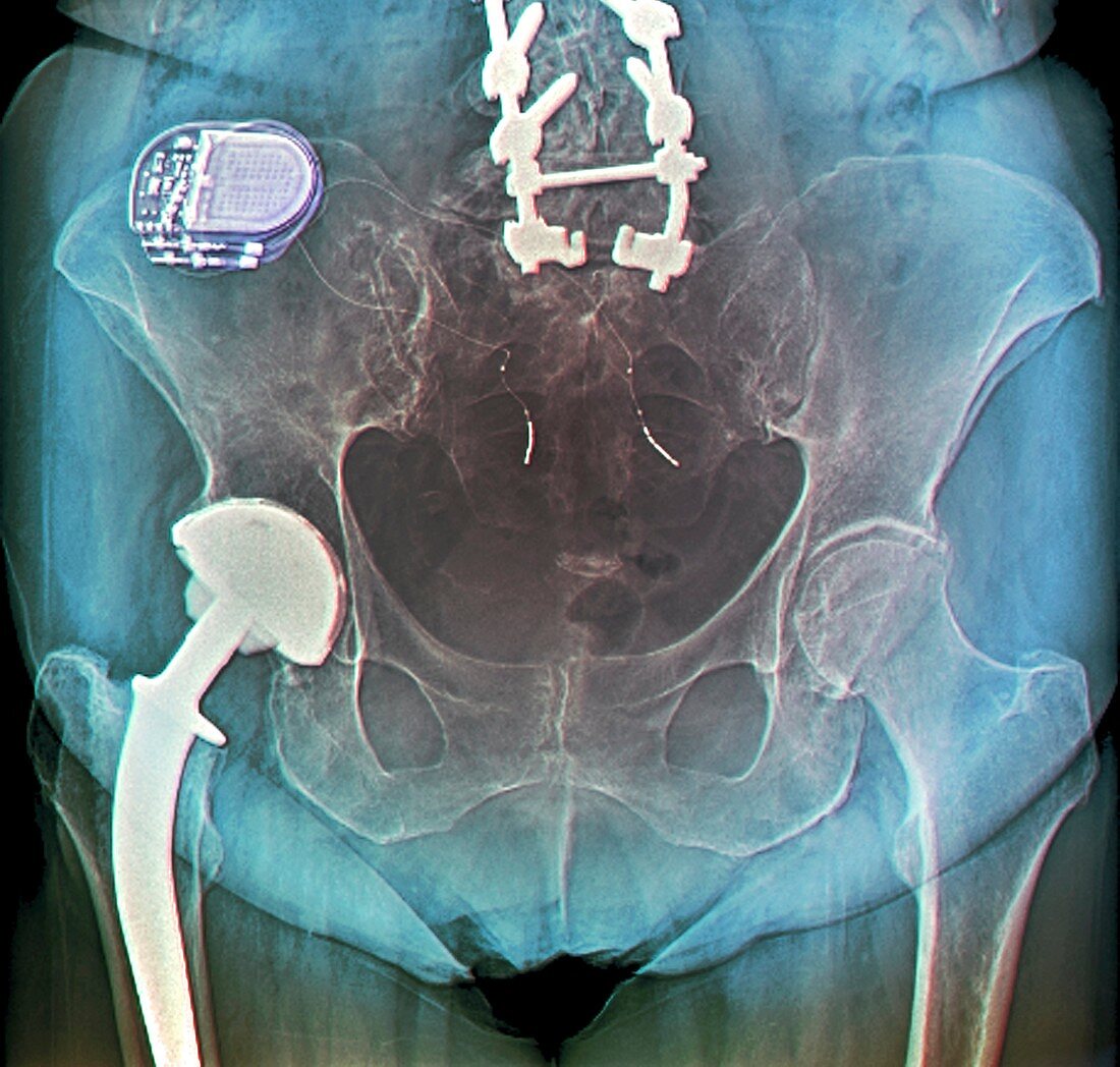 X-ray of implant for incontinence