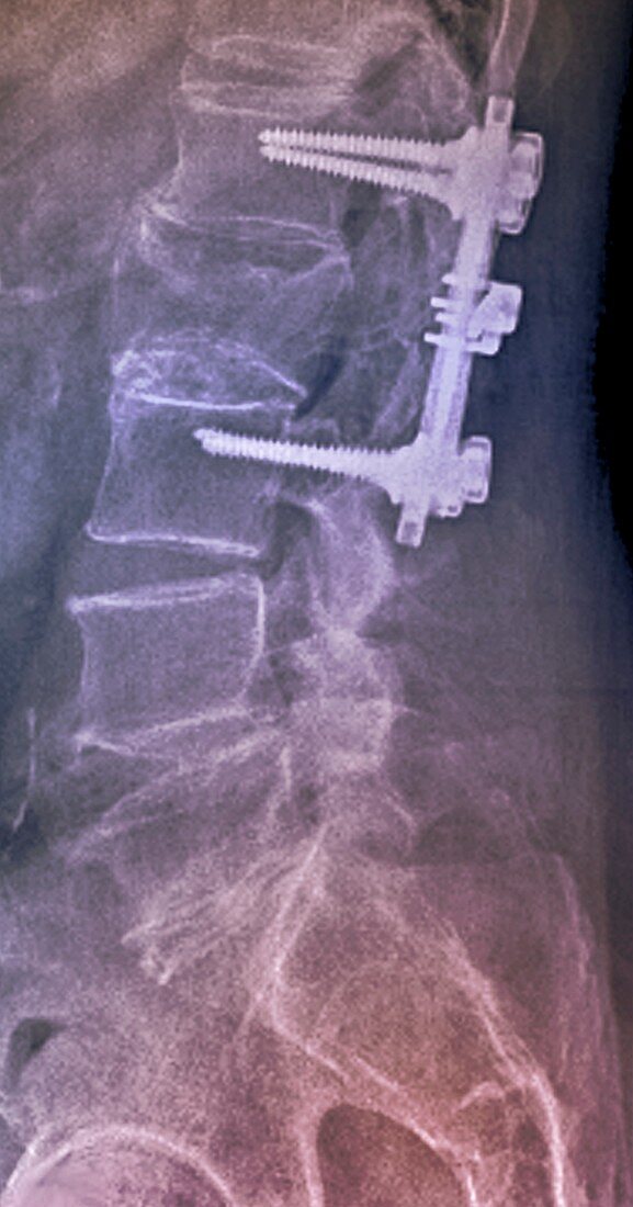 X-ray of pinned spine in osteoporosis