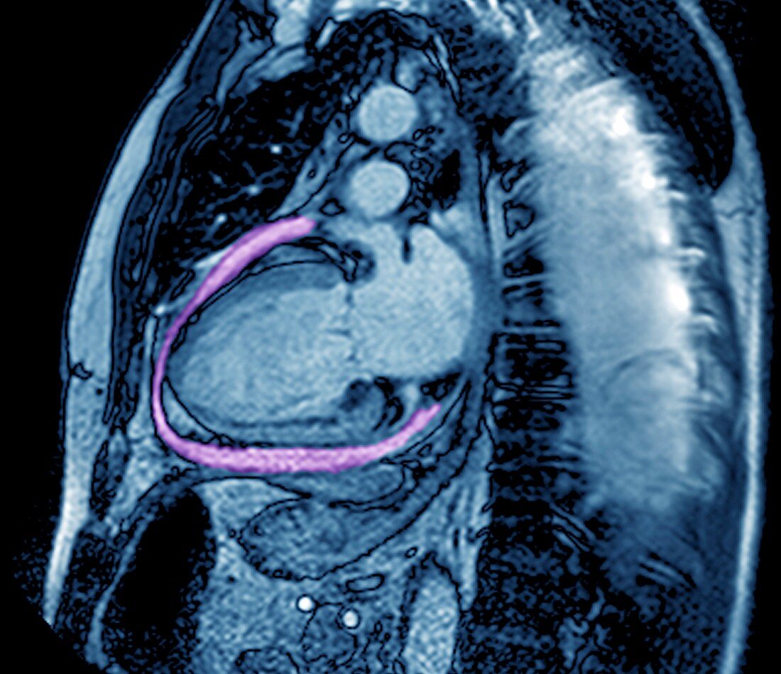 Fluid around heart in heart failure