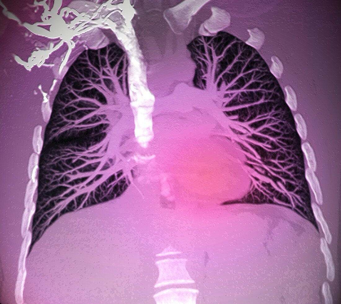 Blood vessels of healthy lungs