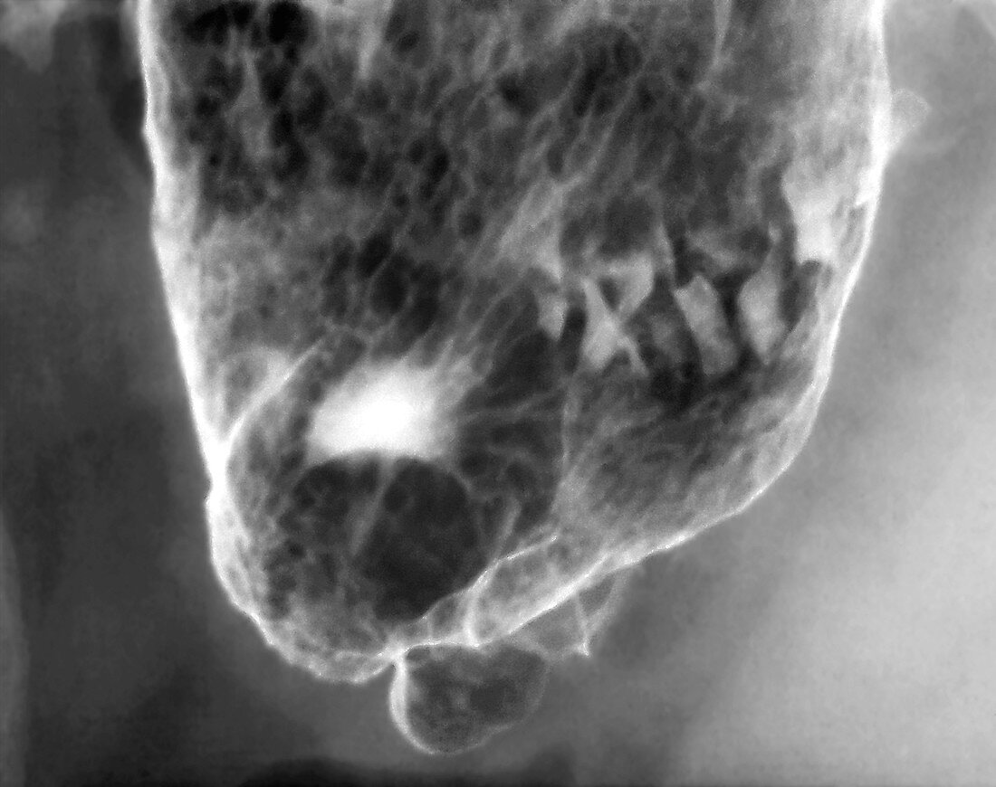 'Stomach (gastric) ulcer,X-ray'