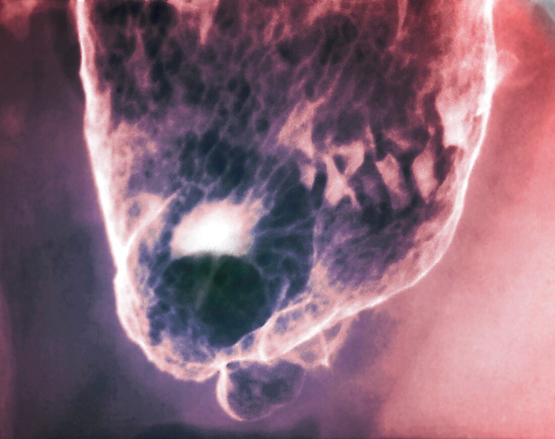 'Stomach (gastric) ulcer,X-ray'