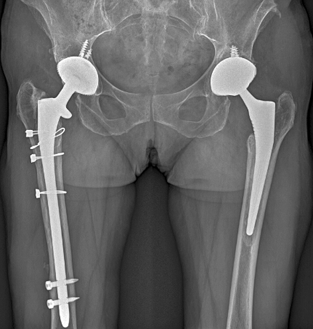 'Double hip replacement,X-ray'