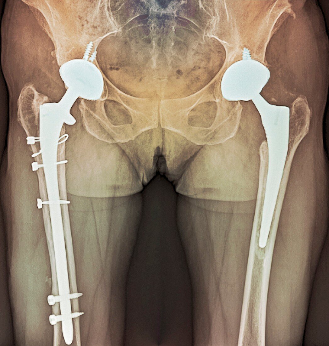 Double hip replacement,X-ray