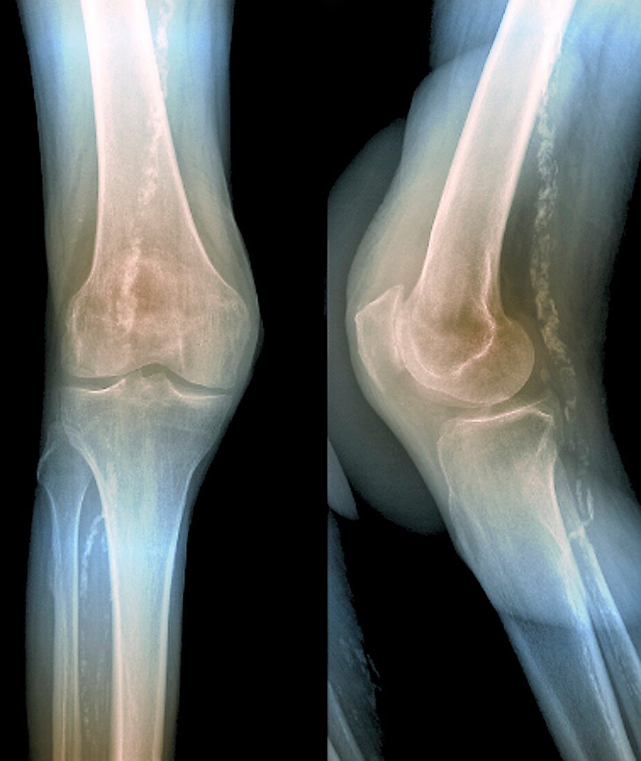 'Osteoarthritis of knee cap,X-ray'