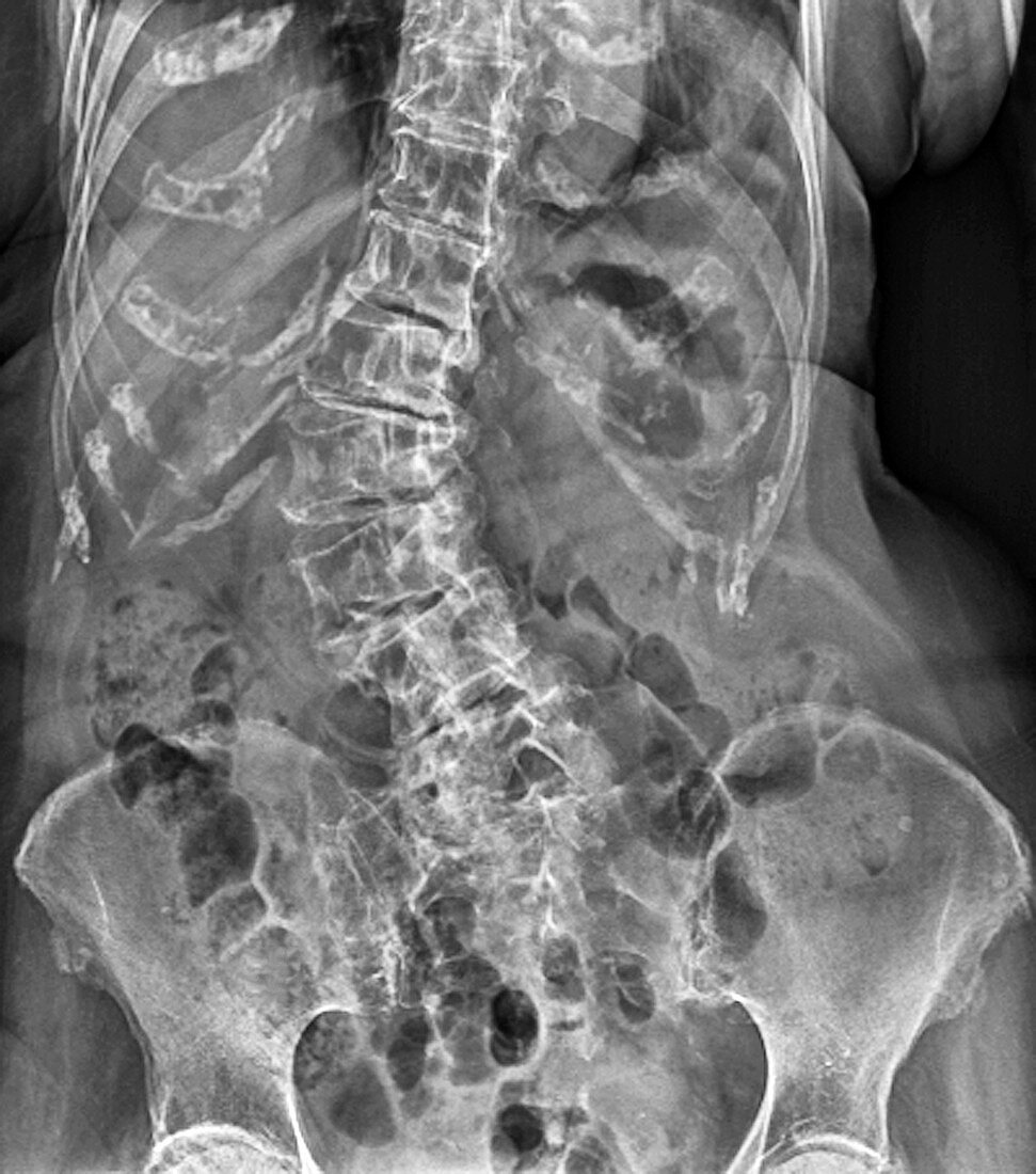 'Spinal curvature (scoliosis),X-ray'