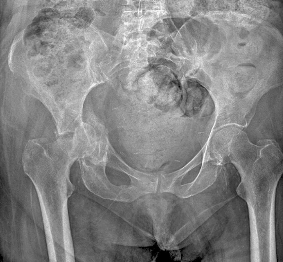'Pelvic fracture,X-ray'