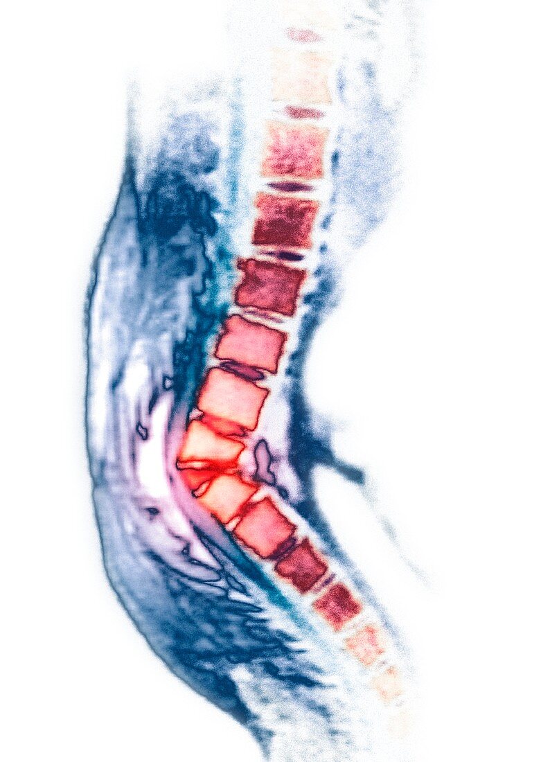 'Kyphosis of the spine,CT scan'