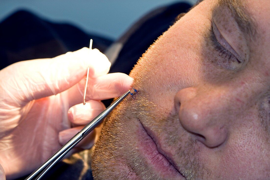 Removing stitches from the face