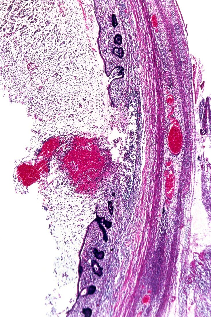 Acute appendicitis,light micrograph