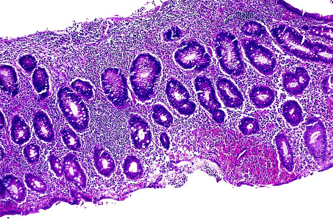 Ulcerative colitis,light micrograph