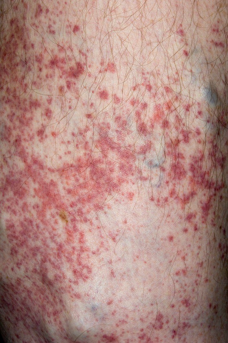 Allergic skin reaction to diathermy pad