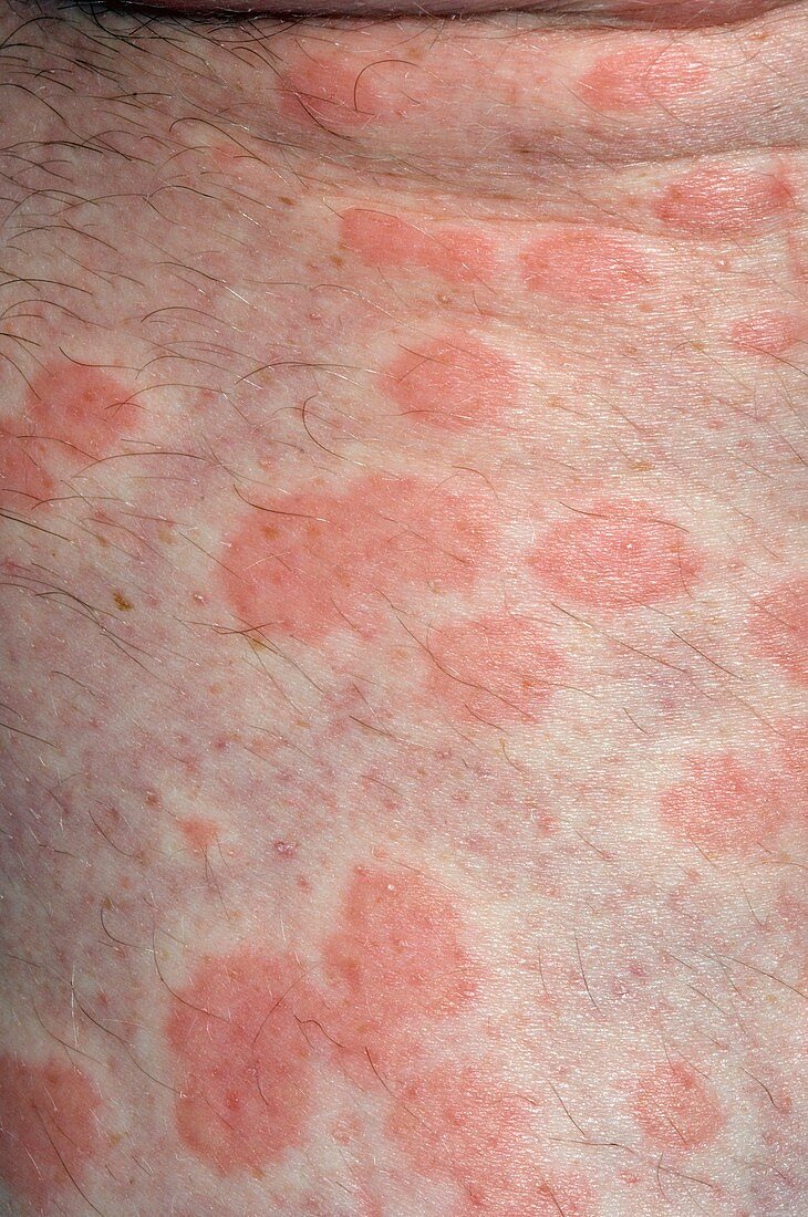 Urticaria rash on the skin