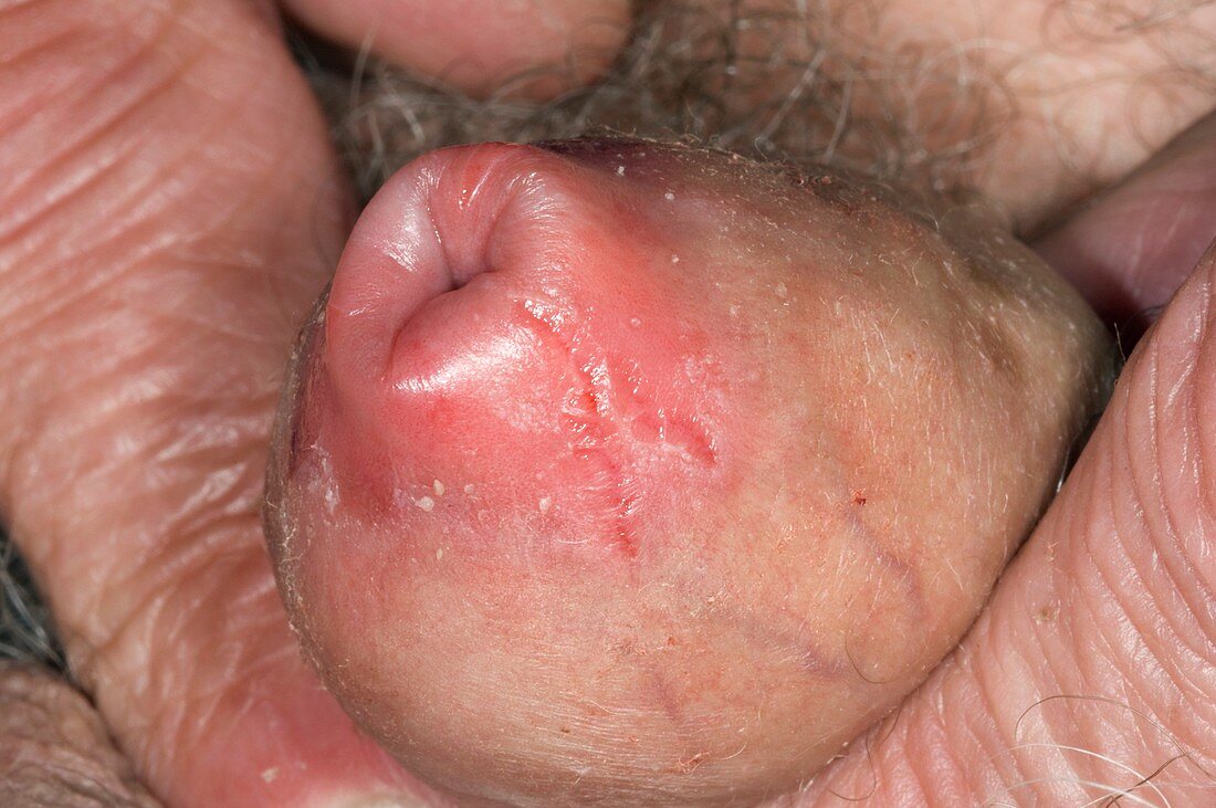 Phimosis of foreskin with Candida