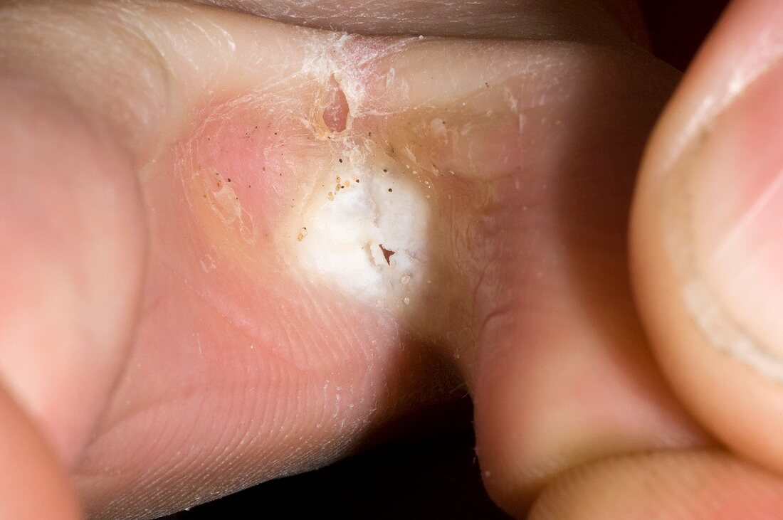 Athlete's foot fungal infection