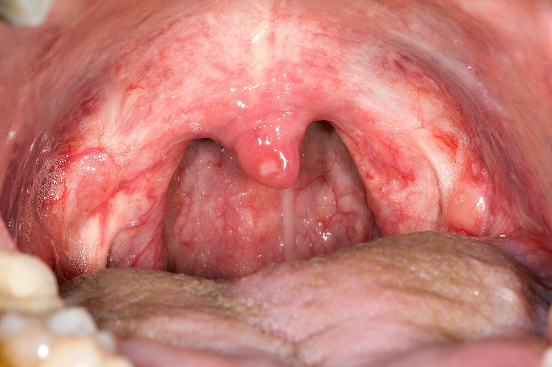 Sore throat (acute pharyngitis)