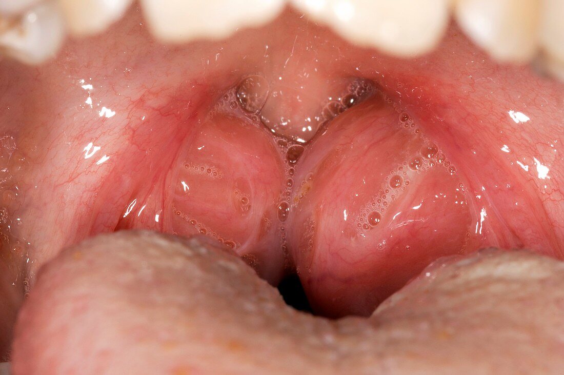 Acute tonsillitis (image 1 of 2)