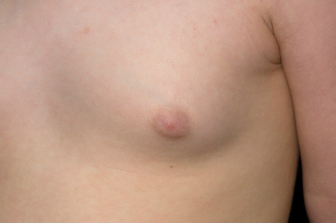 Precocious breast development