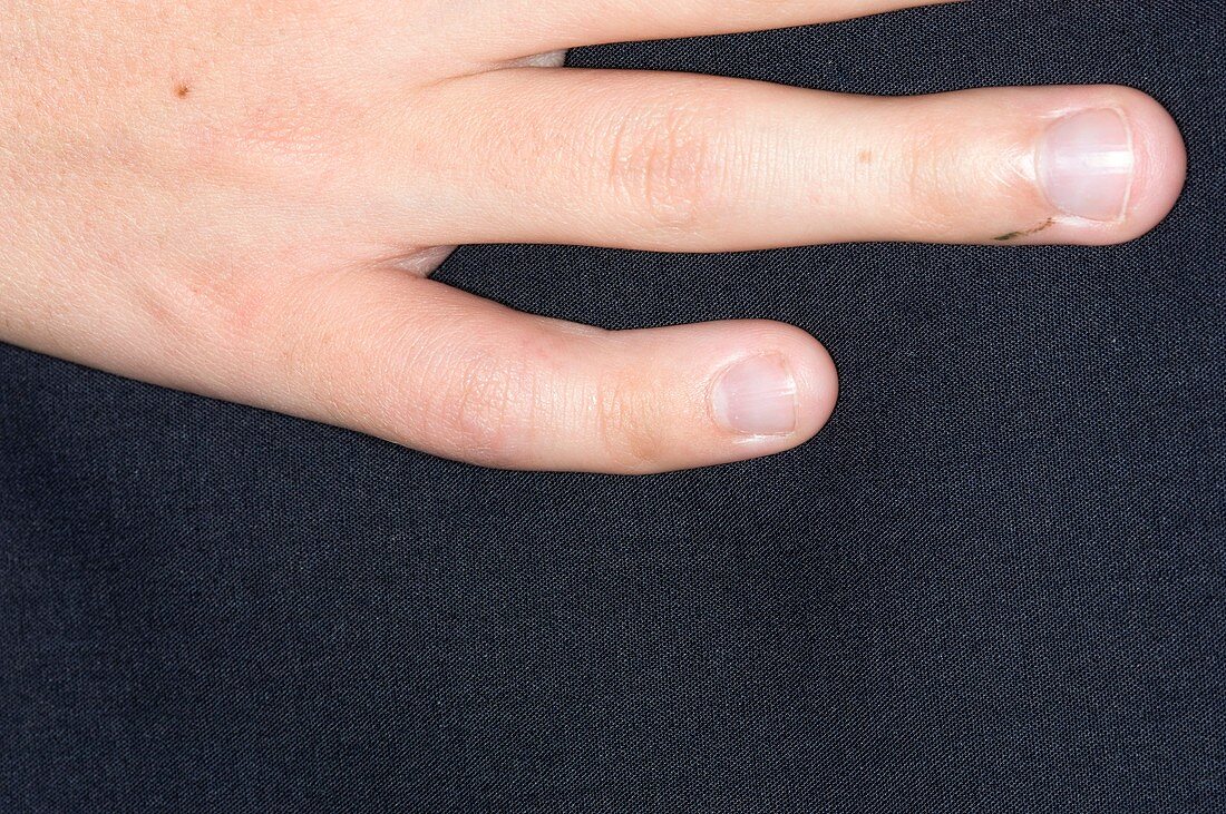 Angulation in finger after fracture