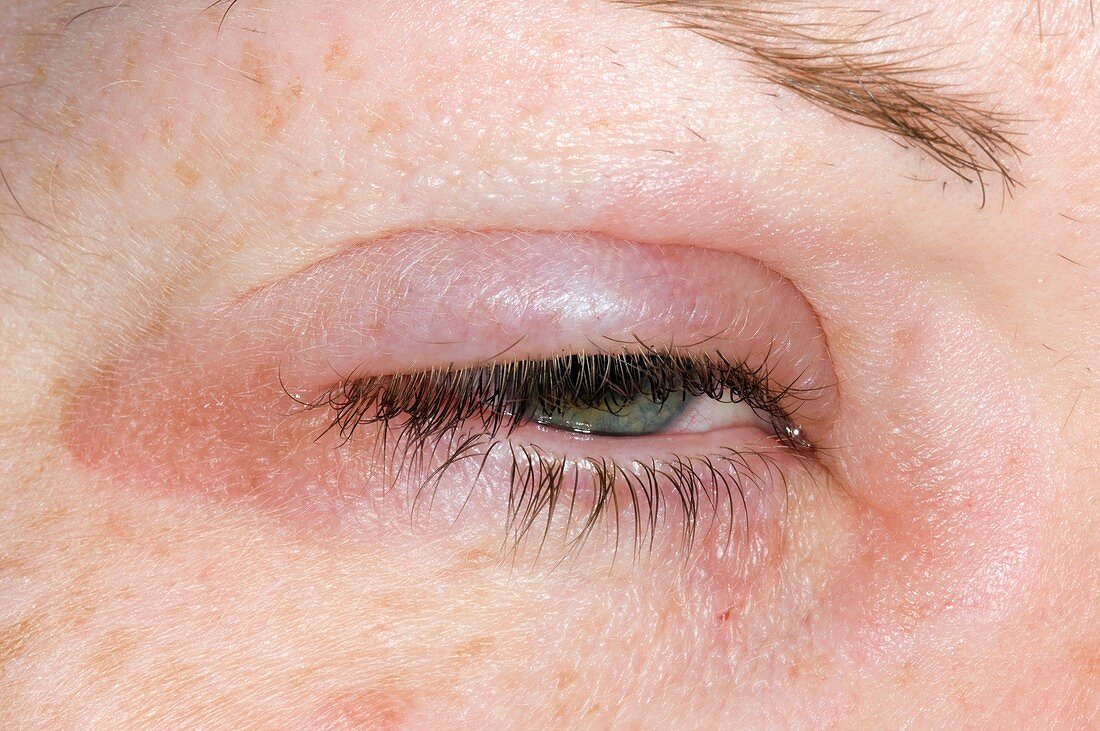 Eyelid swelling due to allergy