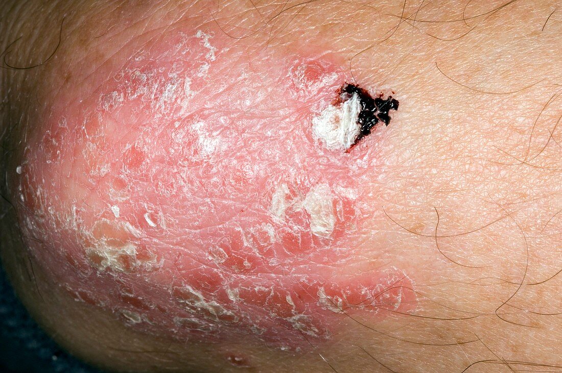 Plaque psoriasis of the elbow