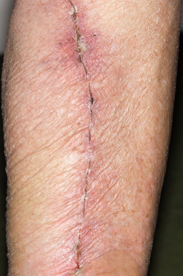 Leg vein scar for heart surgery
