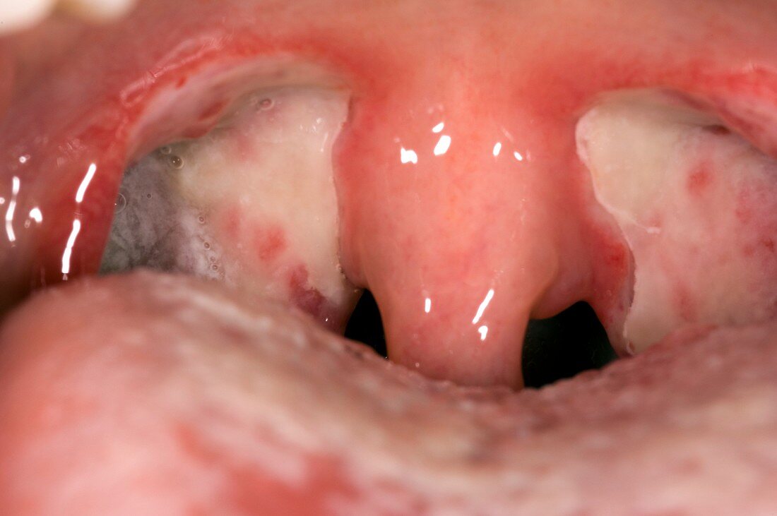 Throat after tonsillectomy (image 2 of 2)