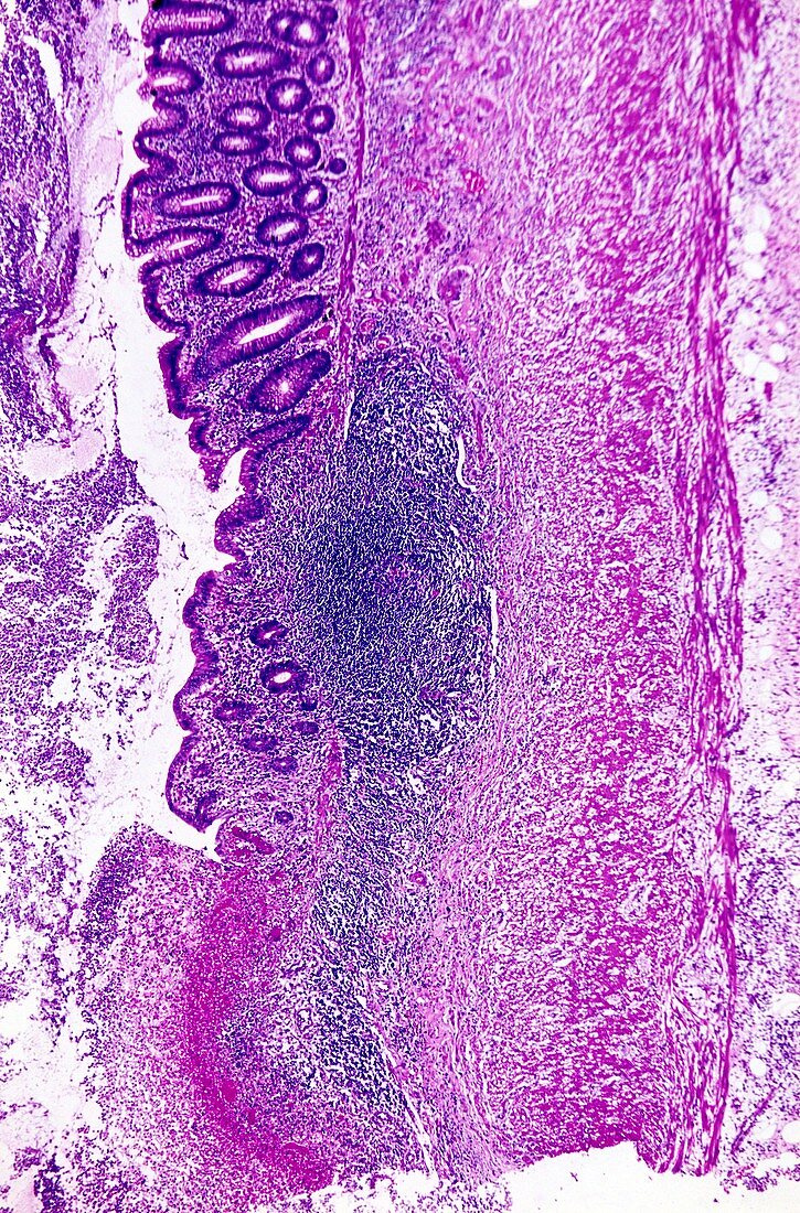 Acute appendicitis,light micrograph