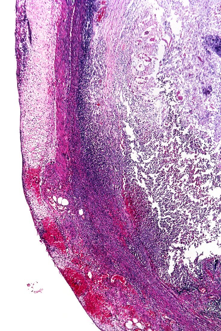 Gangrenous appendicitis,light micrograph