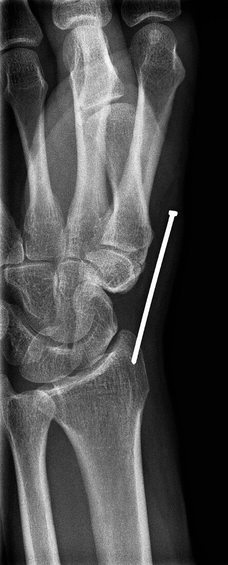 'Nail penetrating the wrist,X-ray'