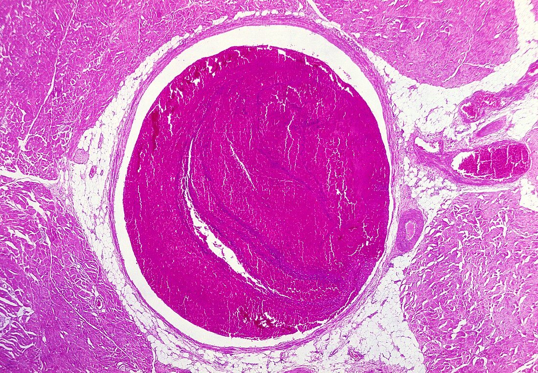 Deep vein thrombosis,light micrograph