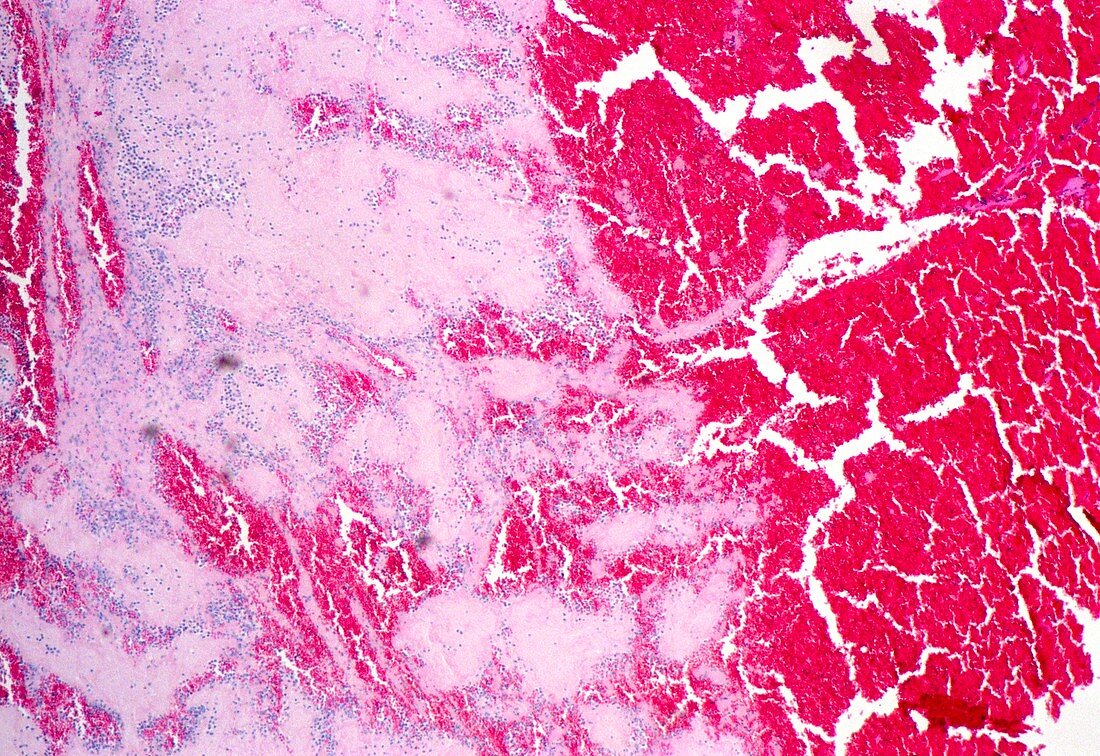 Thrombosis,light micrograph