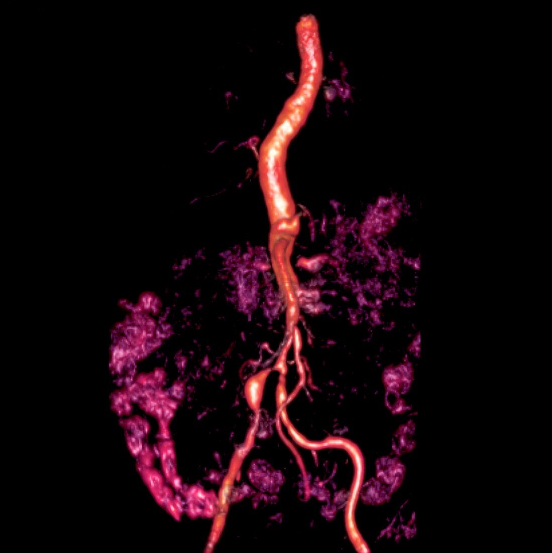 Bilateral renal artery stenosis,MRA scan