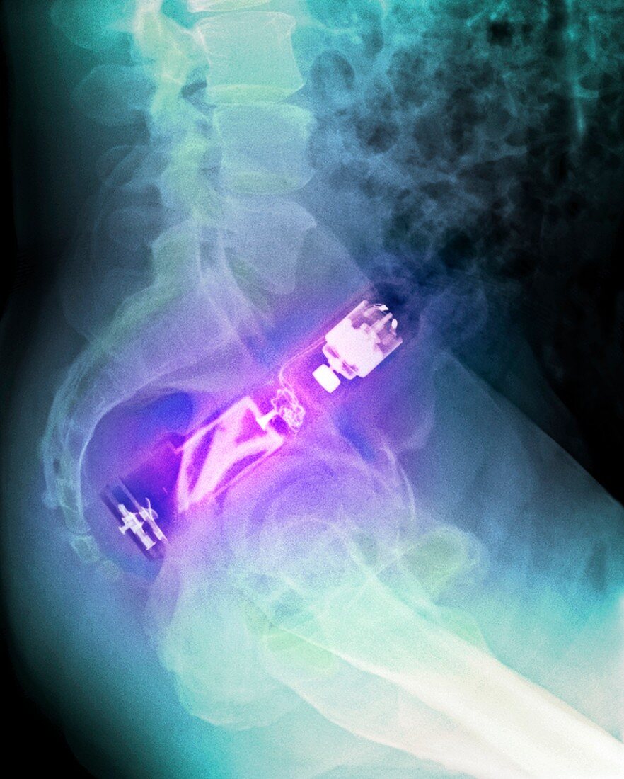'Electric toothbrush in the rectum,X-ray
