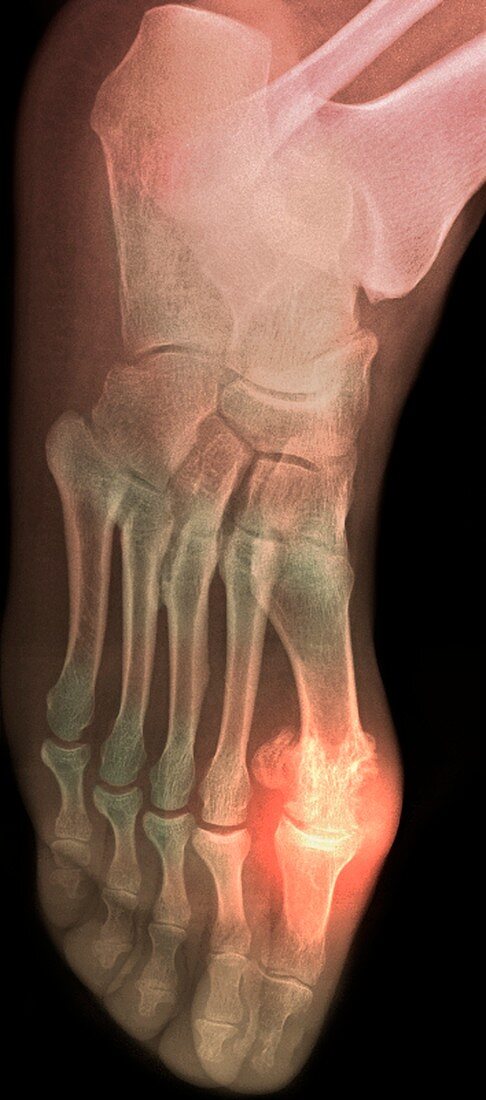 'Gouty foot,X-ray'