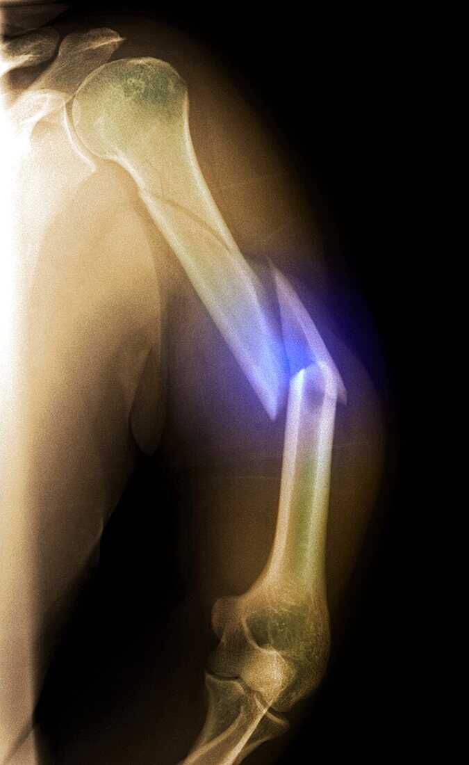 'Splintered arm fracture,X-ray'