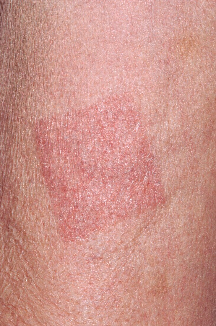 Skin allergy to drug patch