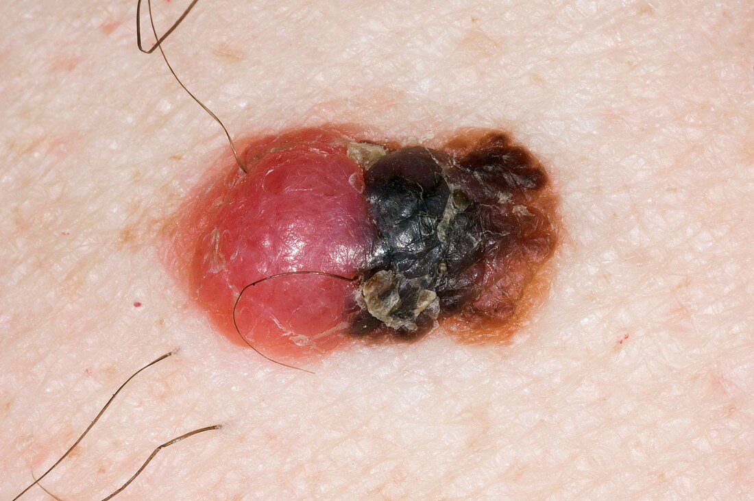 Malignant melanoma on the arm