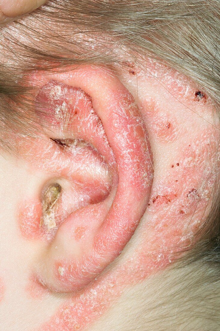 Psoriasis around the ear