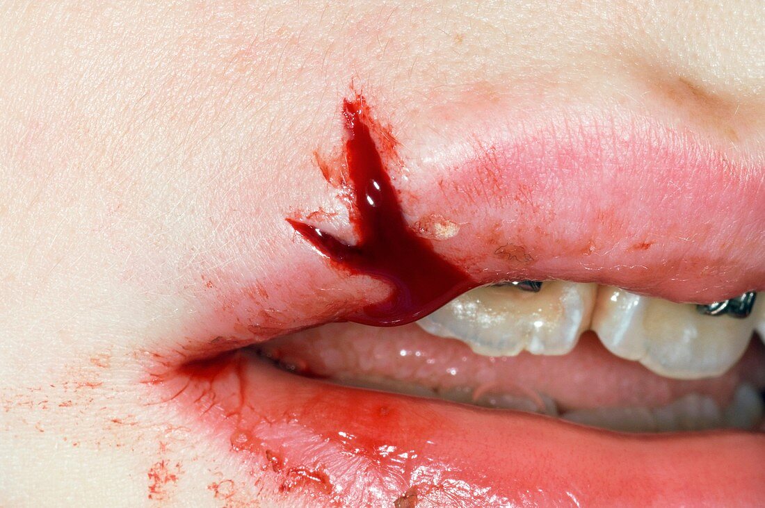 Split lip after a fall