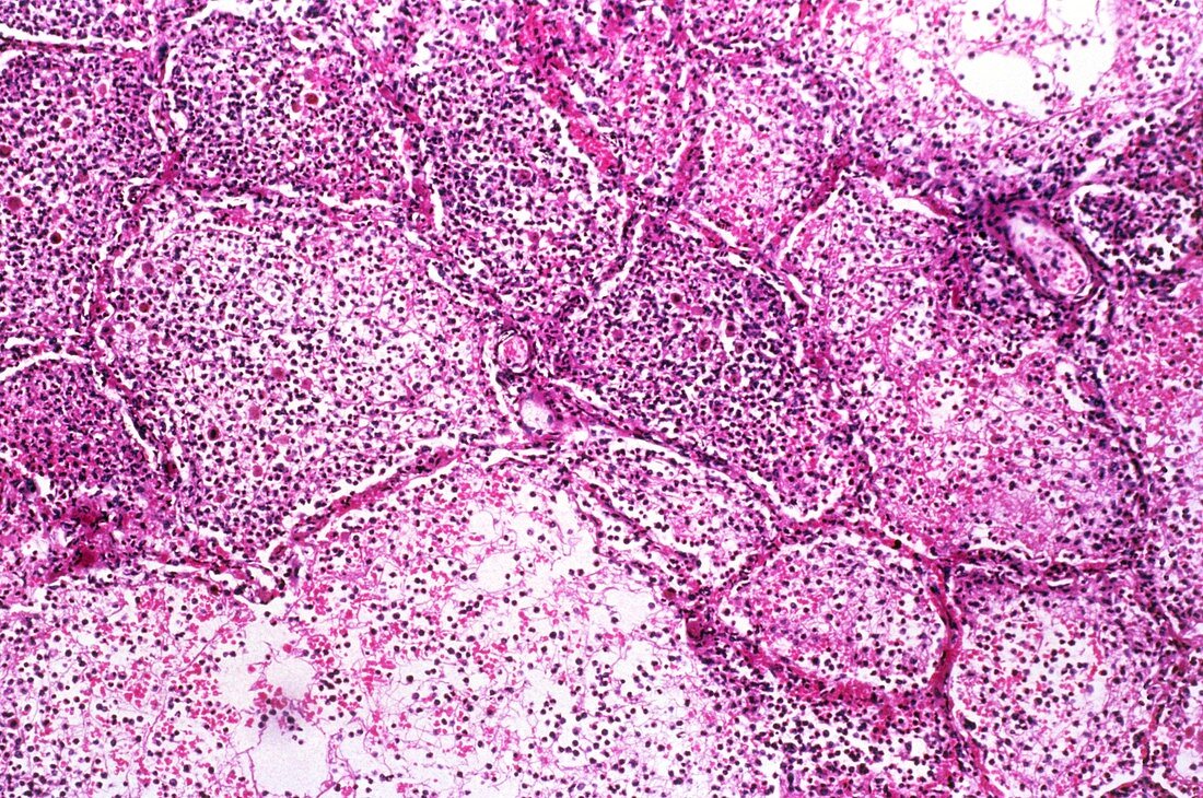 Bronchopneumonia,light micrograph