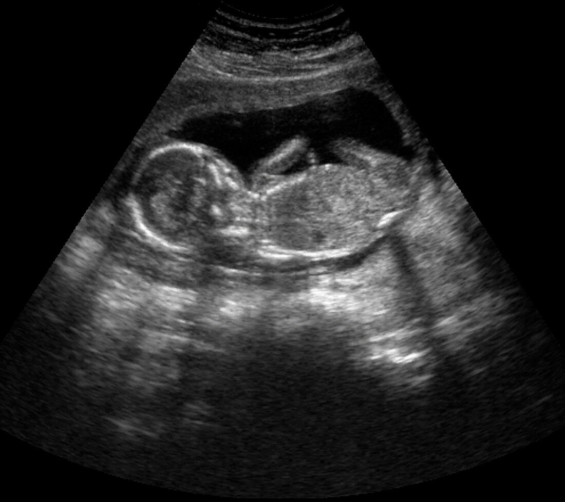 Foetus at 15 weeks,ultrasound