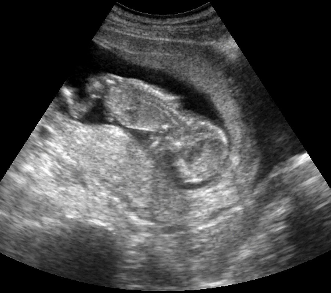 Foetus at 12 weeks,ultrasound