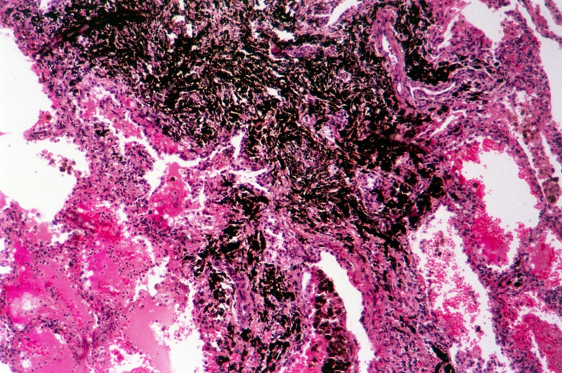 Fibrosis of the lung,light micrograph