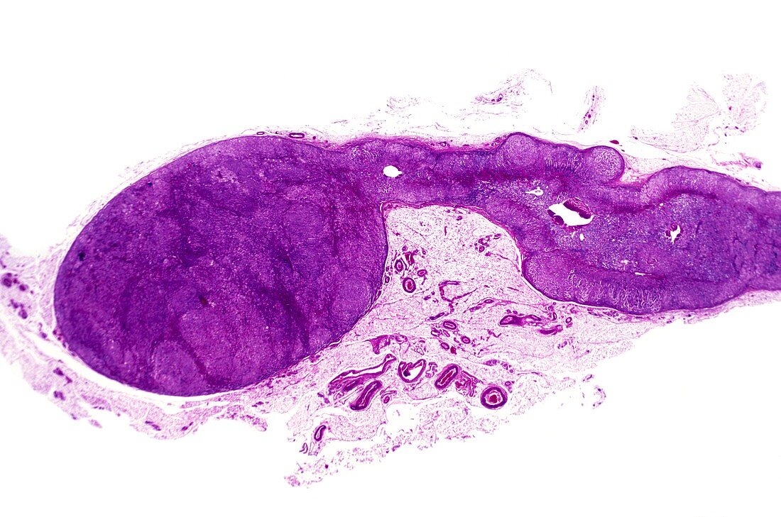Adrenal gland tumour,light micrograph