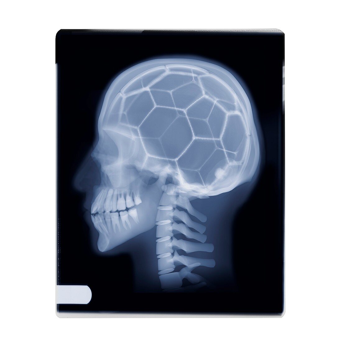 Football on the brain,X-ray image