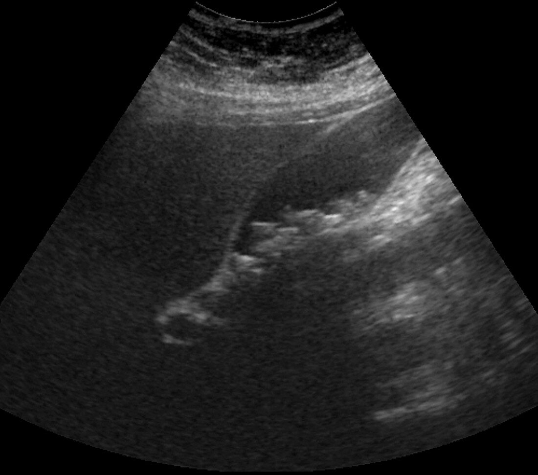 Gallstone,ultrasound scan