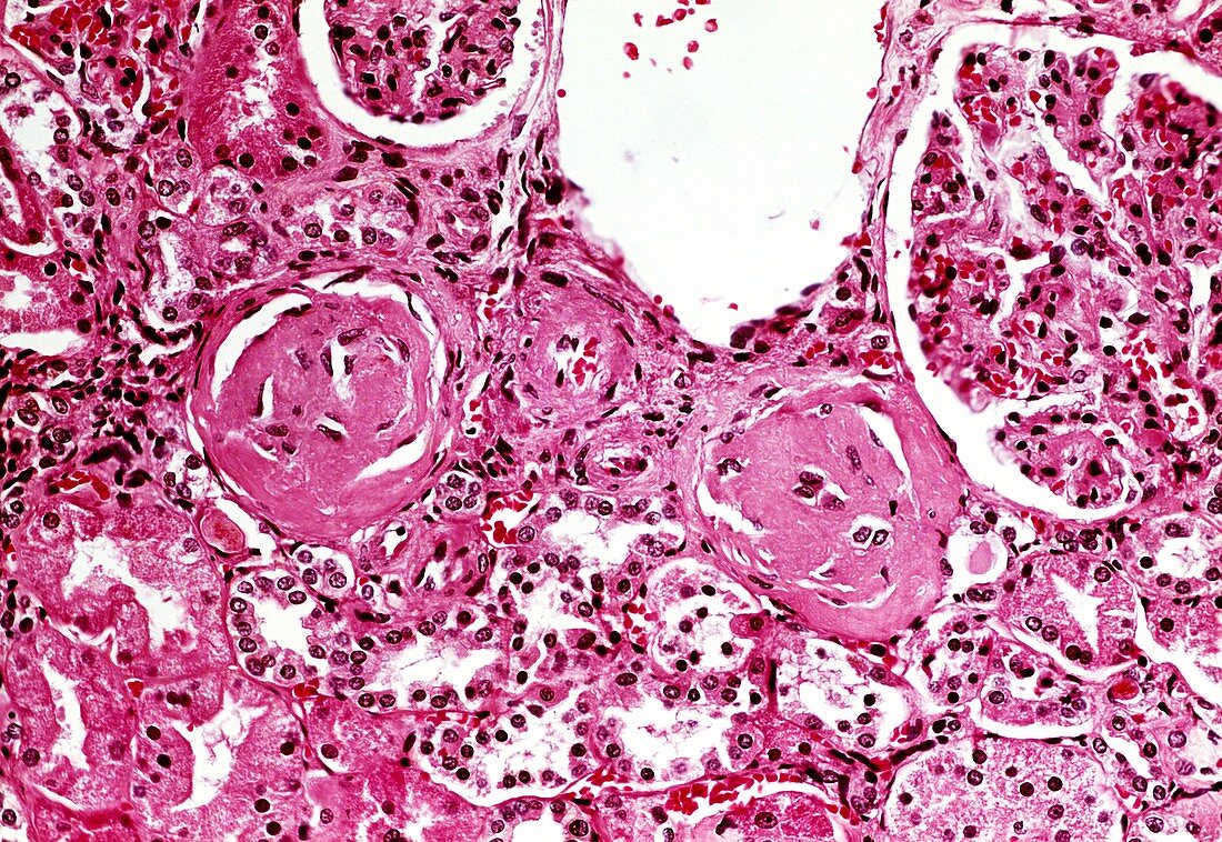 Hypertensive kidney,light micrograph
