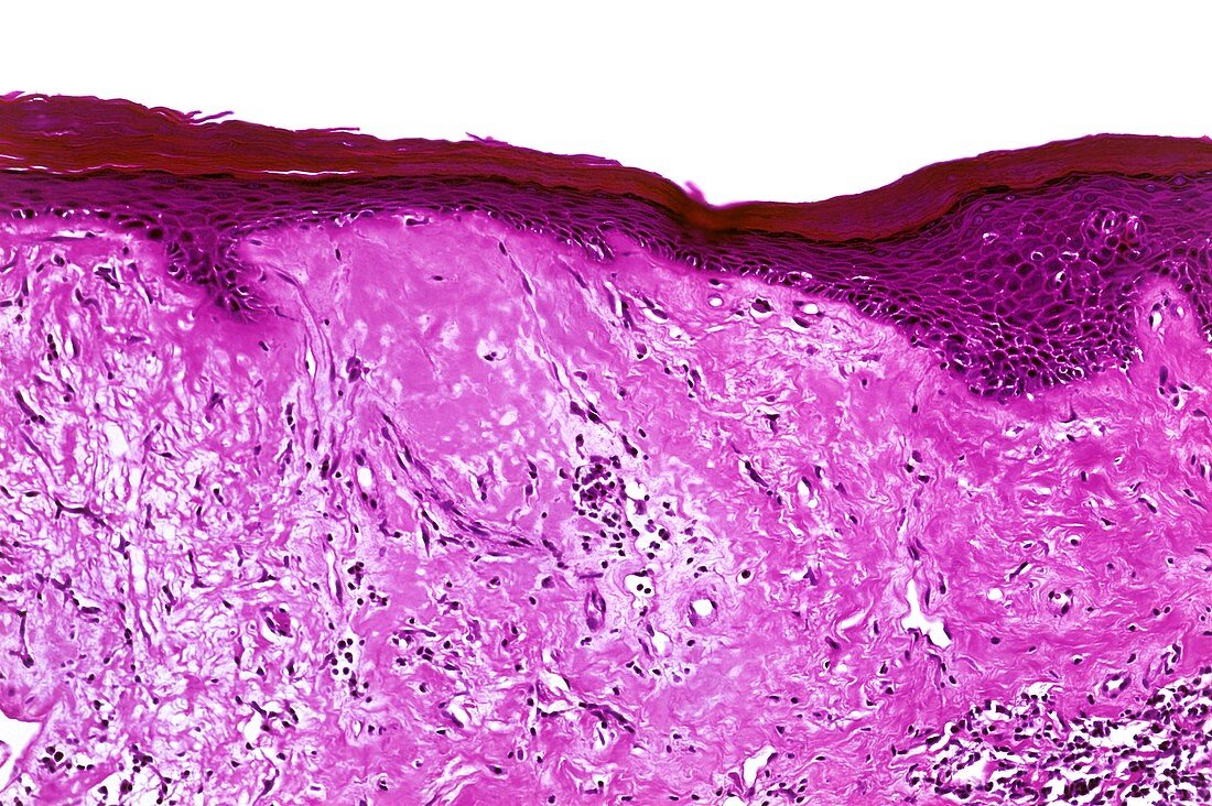 Lichen sclerosus,light micrograph